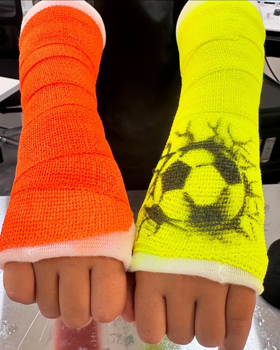 Zwei bunte Schwimmgipse in Orange und Neongelb mit Fußball-Motiv